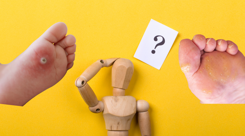 Wart or Corn? 5 Ways to Spot the Difference.