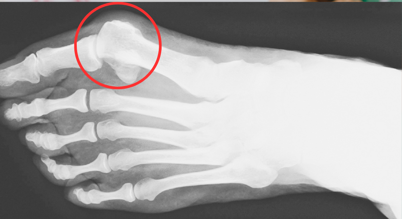 Bunions: What They Are, Why They Happen, and How to Prevent Them